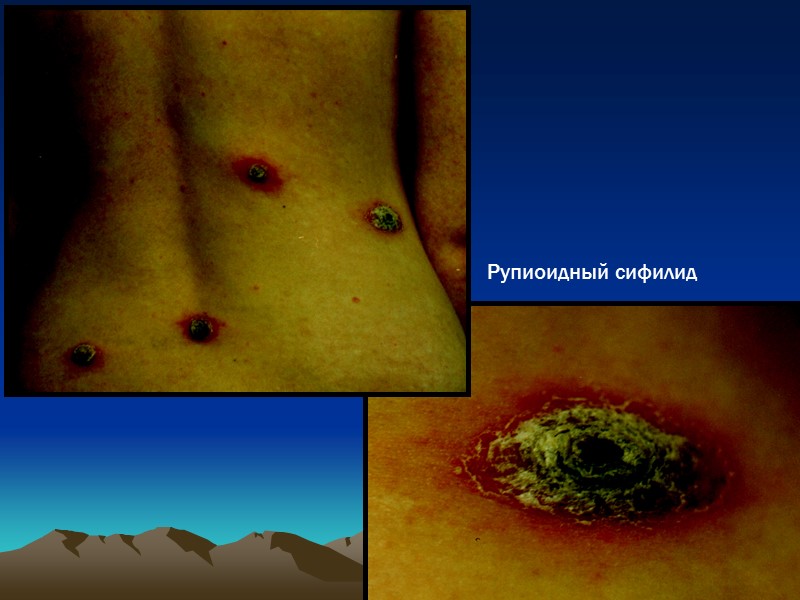 Рупиоидный сифилид